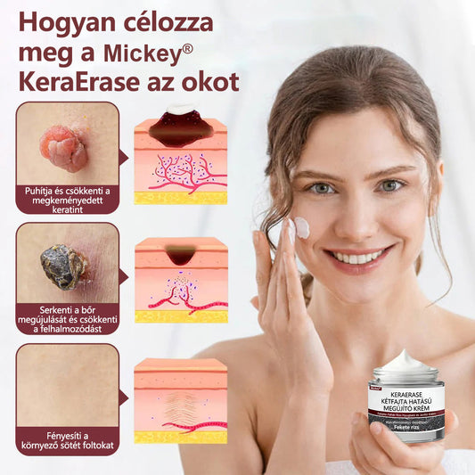 🔥🔥Mickey®KeraErase kettős hatású megújító krém