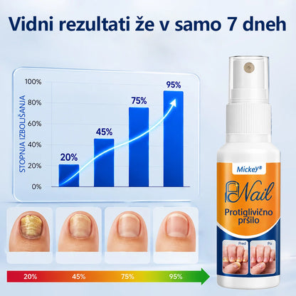 Mickey® pršilo za lajšanje glivic na nohtih