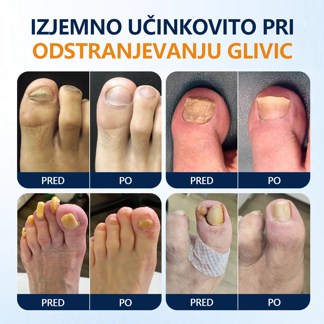 Mickey® pršilo za lajšanje glivic na nohtih