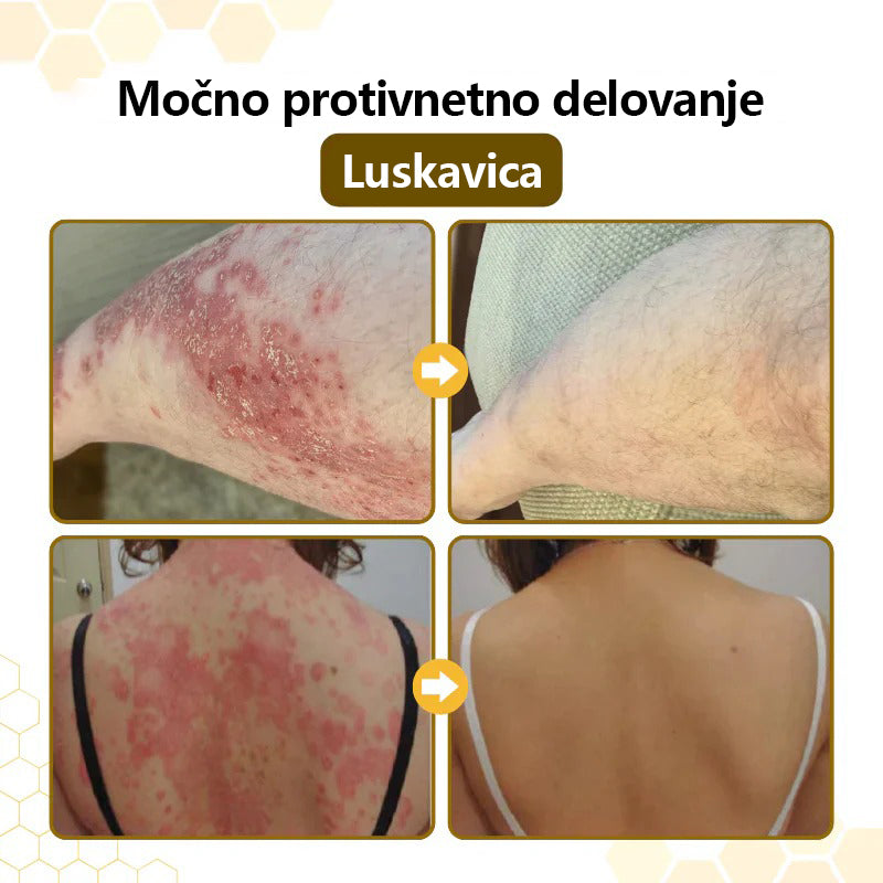 Mickey® PsoriaSoothe Krema za regeneracijo kože s čebeljim strupom
