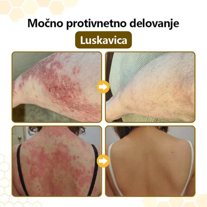 Mickey® PsoriaSoothe Krema za regeneracijo kože s čebeljim strupom