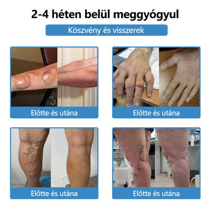 🛡️Mickey® Nano-tűs közös tapasz