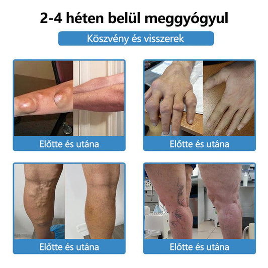 🛡️Mickey® Nano-tűs közös tapasz