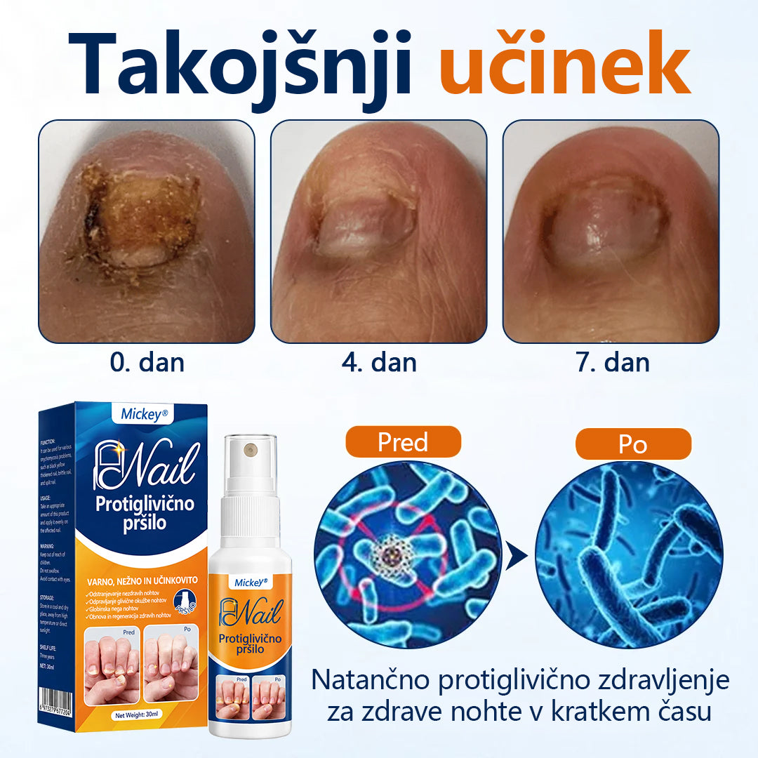 Mickey® pršilo za lajšanje glivic na nohtih