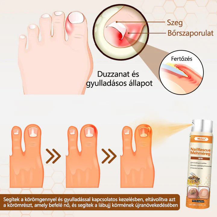 🐝🐝Mickey® NailRescue méhméreg spray