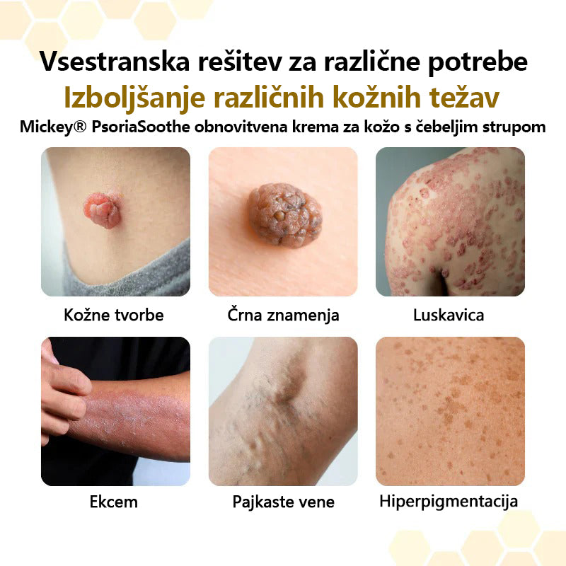 Mickey® PsoriaSoothe Krema za regeneracijo kože s čebeljim strupom