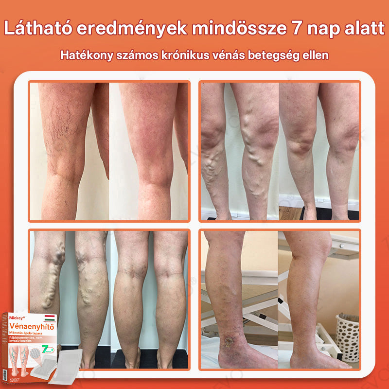 🎁 Mickey® Vein Ease Mikrotű Ápoló Tapasz (Pókvénák, visszér, duzzanat és lábfáradtság ellen) – Utolsó nap! 50% kedvezmény