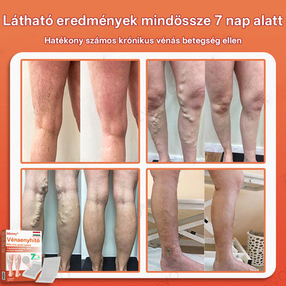 🎁 Mickey® Vein Ease Mikrotű Ápoló Tapasz (Pókvénák, visszér, duzzanat és lábfáradtság ellen) – Utolsó nap! 50% kedvezmény