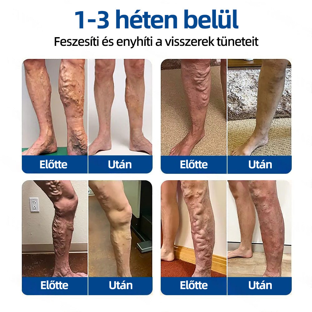 🏅Mickey®VeinTarget mikrotűs tapasz