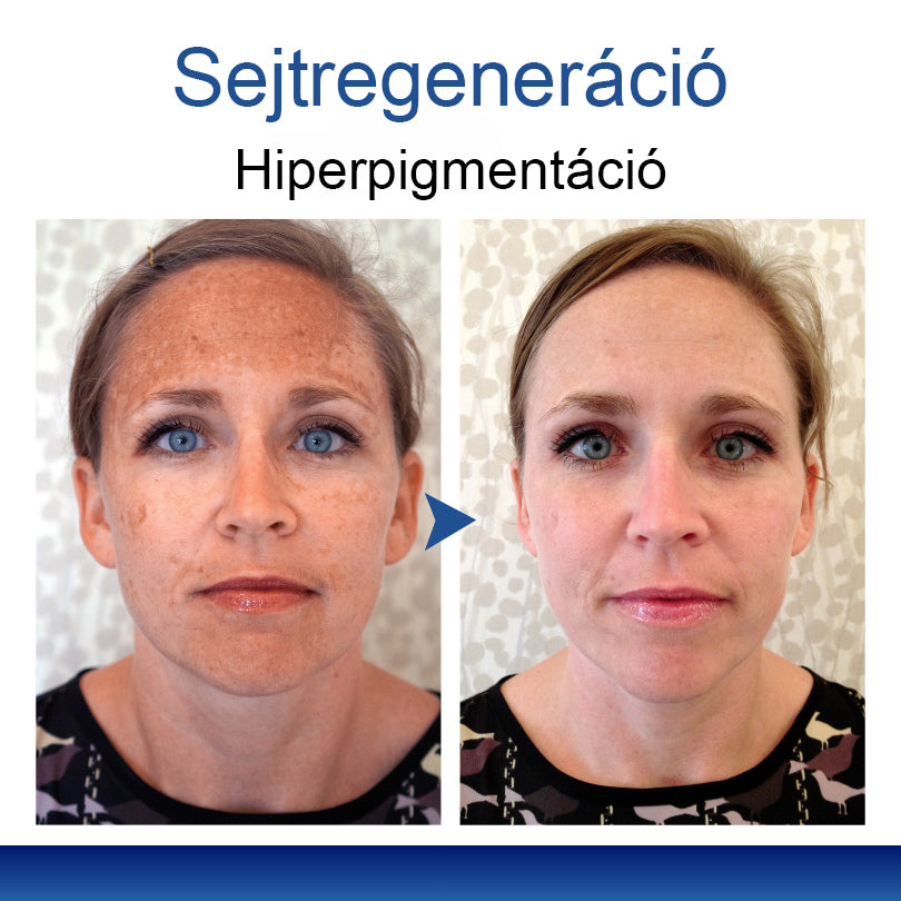 Mickey® DermiPoint Kettős hatású hidrokolloid mikrotűs tapasz🫘