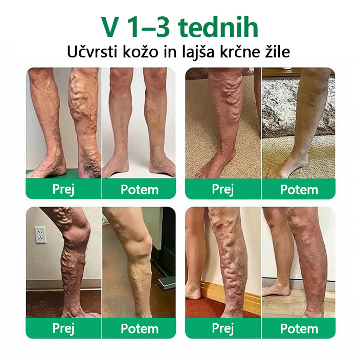 Mickey® VeinEase obliž z mikroiglami ⚡ Dolgotrajno izboljšanje