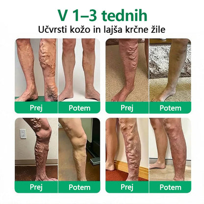 Mickey® VeinEase obliž z mikroiglami ⚡ Dolgotrajno izboljšanje