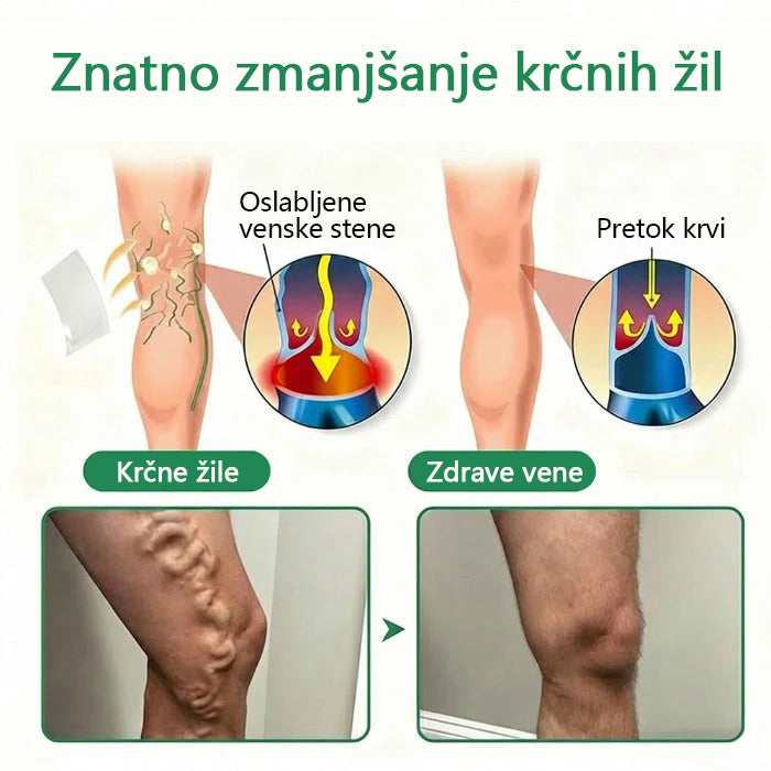 Mickey® VeinEase obliž z mikroiglami ⚡ Dolgotrajno izboljšanje