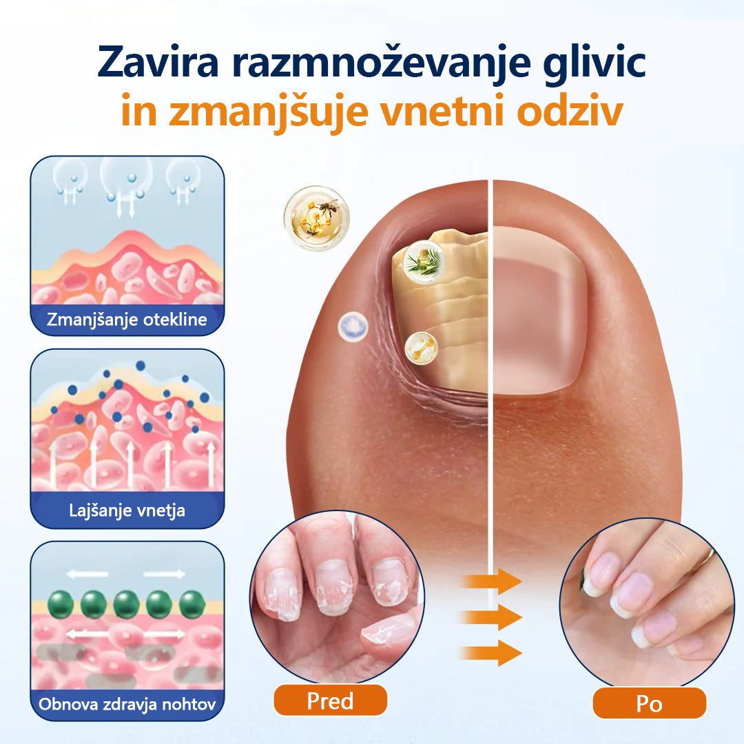 Mickey® pršilo za lajšanje glivic na nohtih