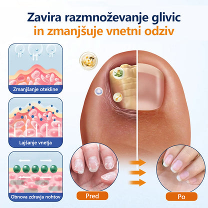 Mickey® pršilo za lajšanje glivic na nohtih
