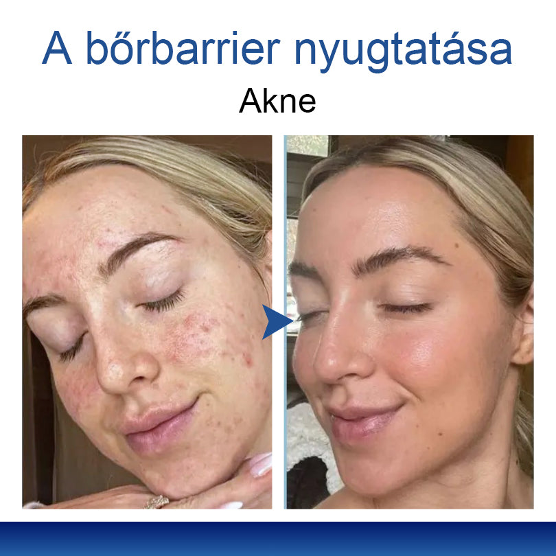 Mickey® DermiPoint Kettős hatású hidrokolloid mikrotűs tapasz🫘
