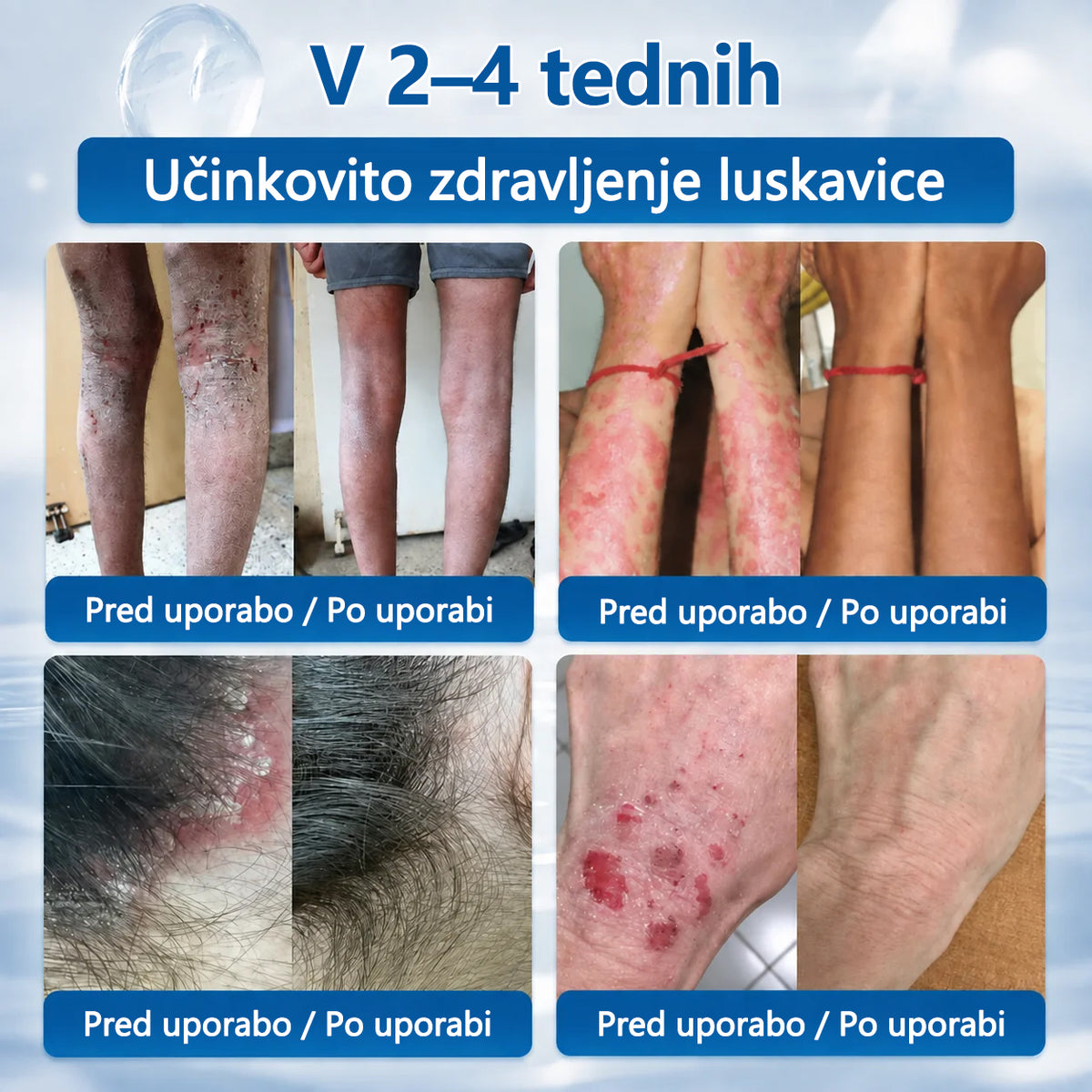 Mickey® Krema za izravnavo nepravilnosti na koži