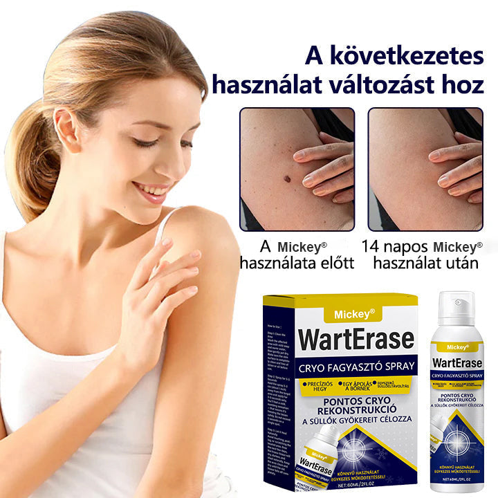 Mickey®WartErase – Fagyasztó Szemölcseltávolító Spray❄️
