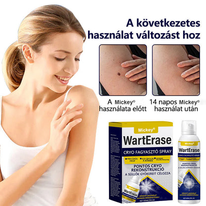Mickey®WartErase – Fagyasztó Szemölcseltávolító Spray❄️