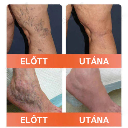 🎁 Mickey® Vein Ease Mikrotű Ápoló Tapasz (Pókvénák, visszér, duzzanat és lábfáradtság ellen) – Utolsó nap! 50% kedvezmény