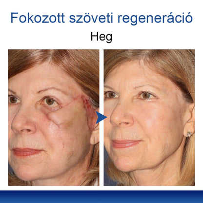 Mickey® DermiPoint Kettős hatású hidrokolloid mikrotűs tapasz🫘