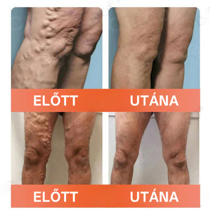🎁 Mickey® Vein Ease Mikrotű Ápoló Tapasz (Pókvénák, visszér, duzzanat és lábfáradtság ellen) – Utolsó nap! 50% kedvezmény