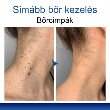 Mickey® DermiPoint Kettős hatású hidrokolloid mikrotűs tapasz🫘
