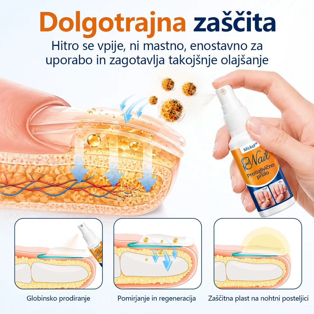 Mickey® pršilo za lajšanje glivic na nohtih