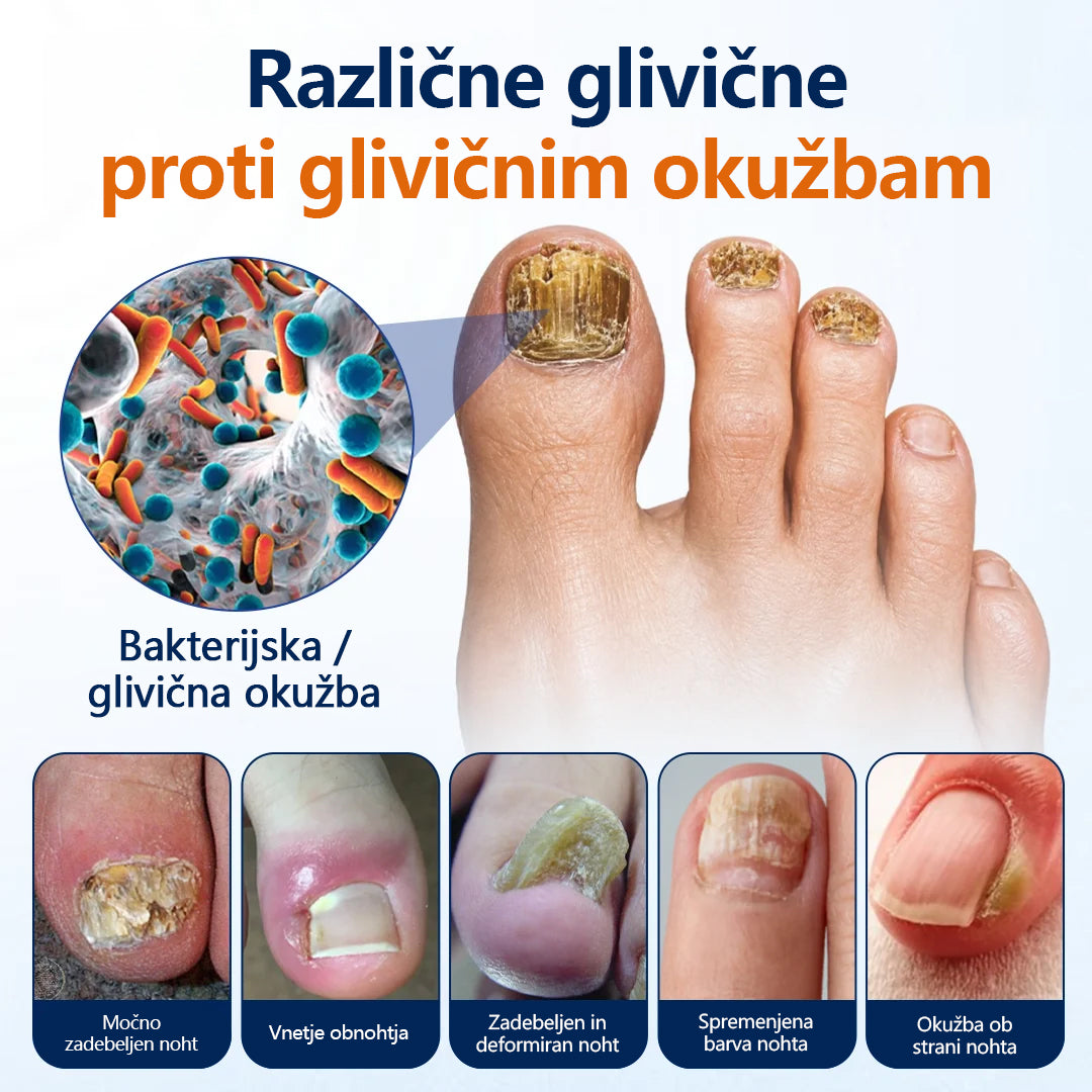 Mickey® pršilo za lajšanje glivic na nohtih