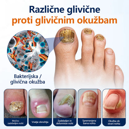 Mickey® pršilo za lajšanje glivic na nohtih