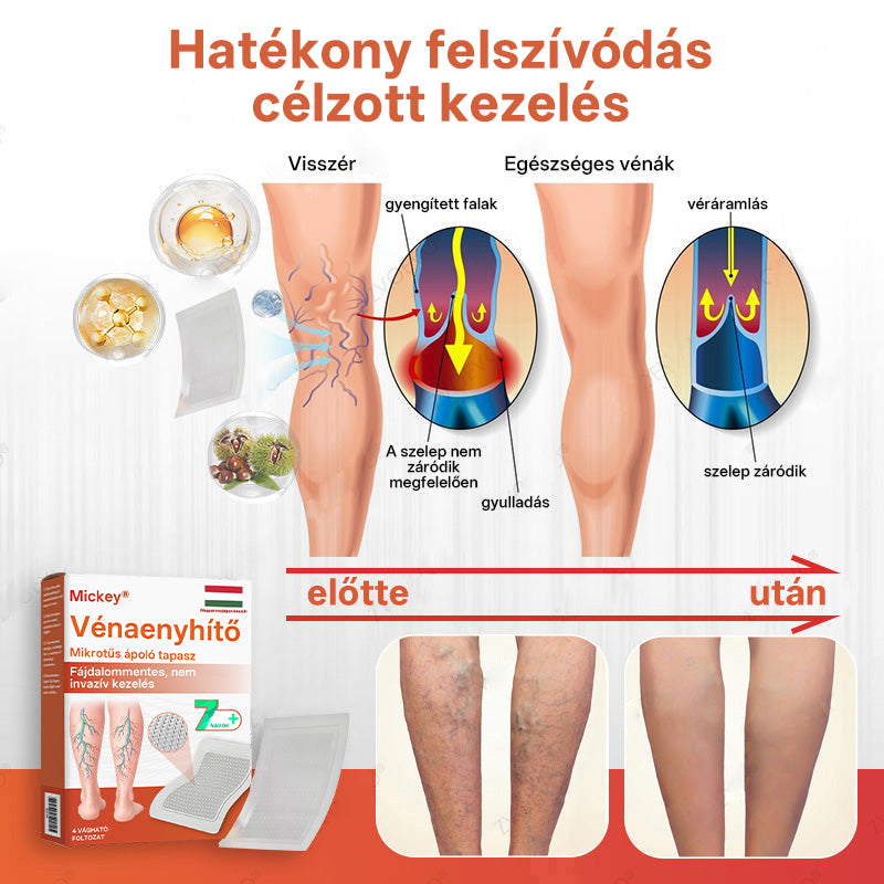 🎁 Mickey® Vein Ease Mikrotű Ápoló Tapasz (Pókvénák, visszér, duzzanat és lábfáradtság ellen) – Utolsó nap! 50% kedvezmény