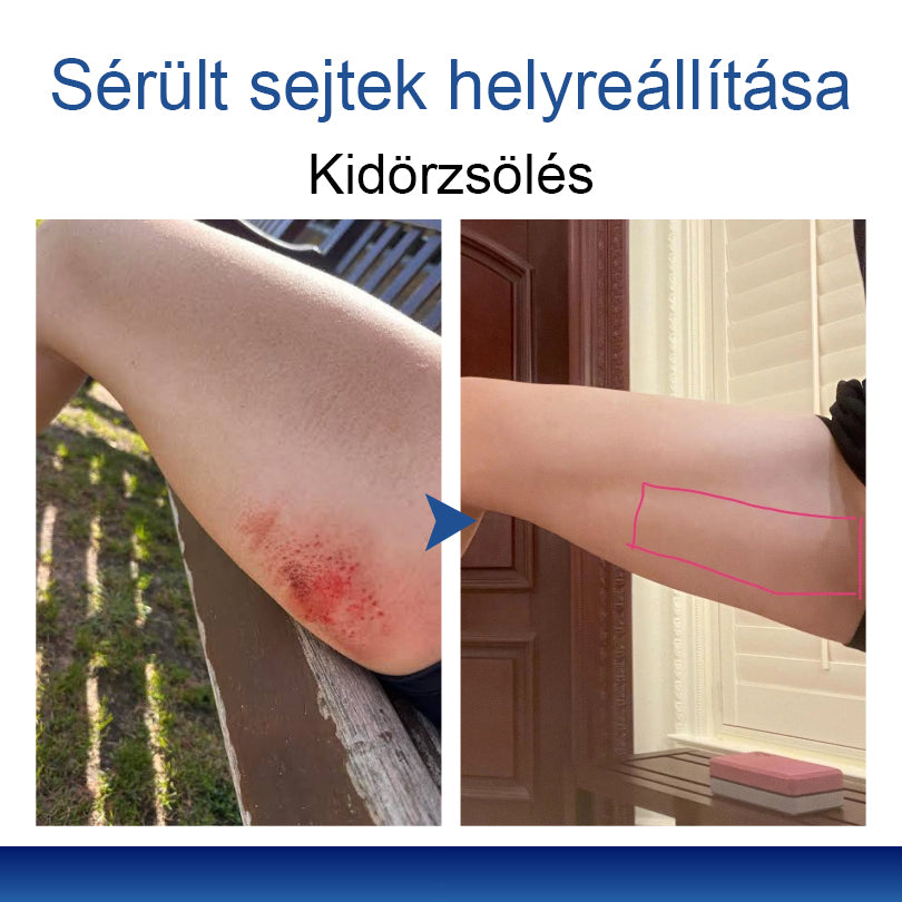 Mickey® DermiPoint Kettős hatású hidrokolloid mikrotűs tapasz🫘